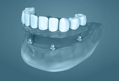 imaxe dun implante dental